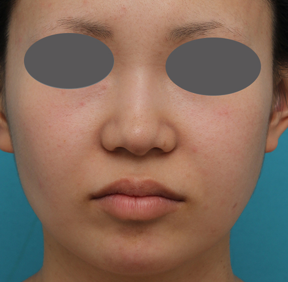 鼻プロテーゼ、鼻先の耳介軟骨移植、小鼻縮小、顎ヒアルロン酸の症例写真,Before,a_ryubi1054_b01.jpg