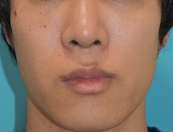 鼻尖形成（鼻尖縮小・だんご鼻修正）,鼻尖形成の症例写真,After（1ヶ月後）,ba_bisen028_b01.jpg