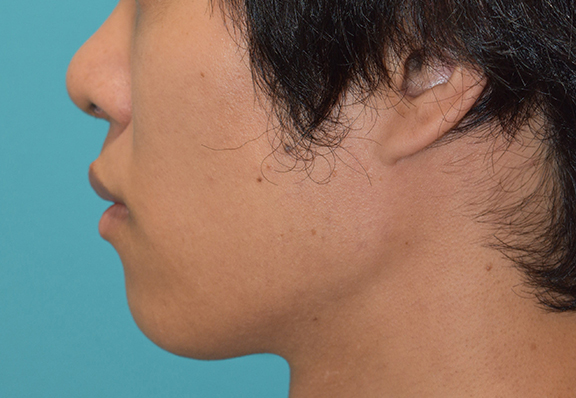 鼻尖形成（鼻尖縮小・だんご鼻修正）,鼻尖形成の症例写真,After（1ヶ月後）,ba_bisen028_b02.jpg