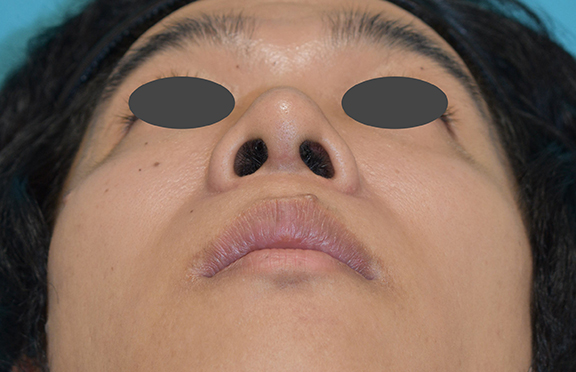 鼻尖形成（鼻尖縮小・だんご鼻修正）,鼻尖形成の症例写真,After（1ヶ月後）,ba_bisen028_b03.jpg