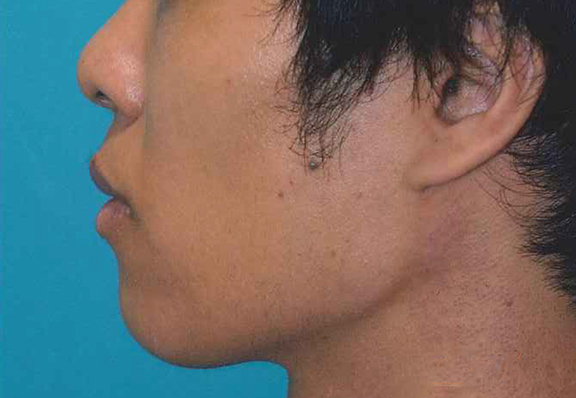 鼻尖形成（鼻尖縮小・だんご鼻修正）,鼻尖形成の症例写真,Before,ba_bisen028_b02.jpg