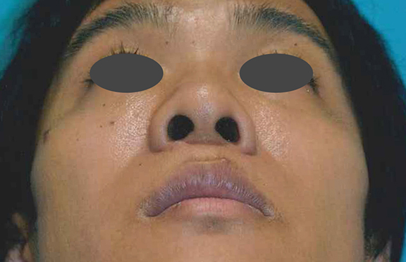 鼻尖形成（鼻尖縮小・だんご鼻修正）,鼻尖形成の症例写真,Before,ba_bisen028_b03.jpg