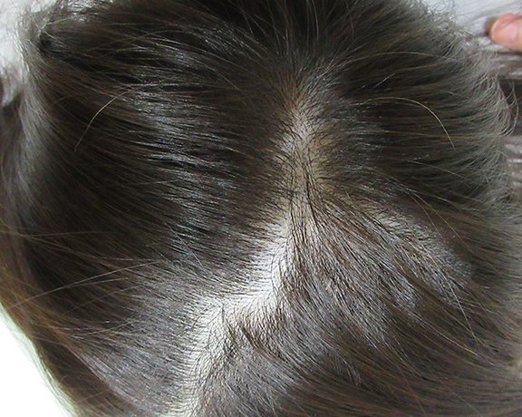 AGA治療（高須式メディカル育毛プログラム）,HARG治療（女性の円形脱毛）の症例写真,After（6回治療終了後 4ヶ月経過）,ba_aga_josei001_b.jpg