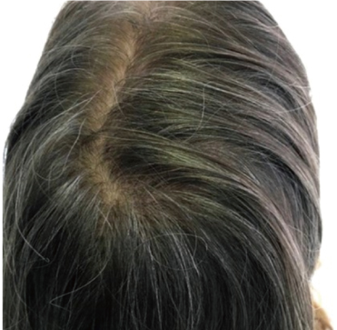 ヘアライン（白髪・育毛治療）,ヘアラインで白髪と薄毛を治療した症例写真,After（治療期間1年）,ba_hairline001_a01.jpg