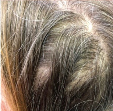 ヘアライン（白髪・育毛治療）,ヘアラインで白髪と薄毛を治療した症例写真,Before,ba_hairline001_b01.jpg
