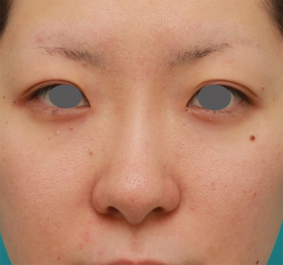 隆鼻注射（ヒアルロン酸注射）,長期持続型ヒアルロン酸注射で鼻を高くし、綺麗に鼻筋を通した症例写真,After（1週間後）,ba_ryubichusha44_a01.jpg
