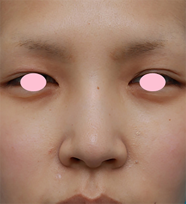 鼻翼縮小（小鼻縮小）,鼻翼（小鼻）縮小手術で、自然な範囲内で最大限小鼻を小さくした症例写真,手術前,mainpic_biyoku06a.jpg