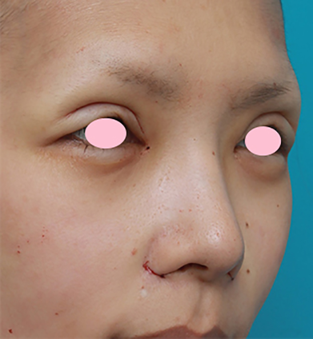 鼻翼縮小（小鼻縮小）,鼻翼（小鼻）縮小手術で、自然な範囲内で最大限小鼻を小さくした症例写真,手術直後,mainpic_biyoku06f.jpg