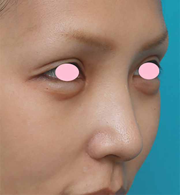 鼻翼縮小（小鼻縮小）,鼻翼（小鼻）縮小手術で、自然な範囲内で最大限小鼻を小さくした症例写真,3ヶ月後,mainpic_biyoku06h.jpg
