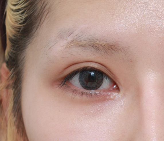 傷跡,傷跡修正手術の症例写真,Before,ba_keisei18_b.jpg