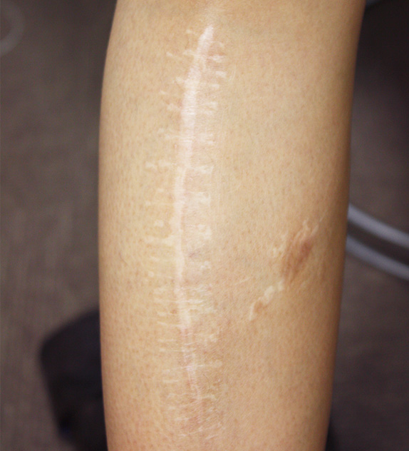 傷跡,傷跡の症例写真　脚の傷跡を手術で修正,Before,ba_keisei11_b.jpg