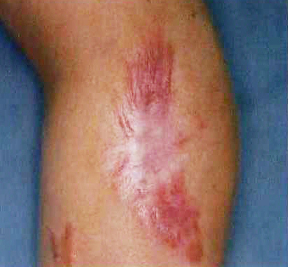 傷跡,傷跡の症例写真　Vビームによる治療,Before,ba_keisei09_b.jpg