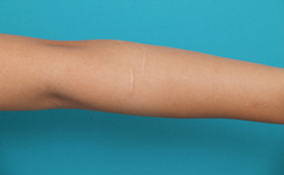傷跡,リストカット・根性焼き,リストC.の傷跡を切除縫縮した症例写真,Before,ba_keisei20_b.jpg