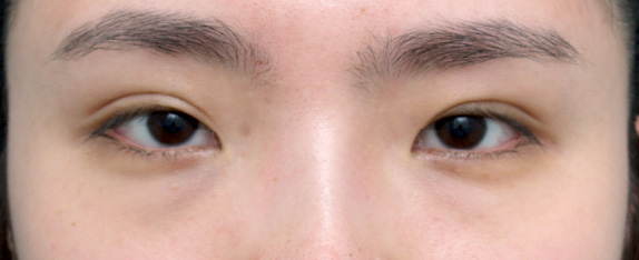眼瞼下垂（がんけんかすい）,他院で受けた手術の修正（二重まぶた・目もと）,眼瞼下垂（がんけんかすい） 他院施術の修正手術症例,Before,ba_ganken23_b.jpg