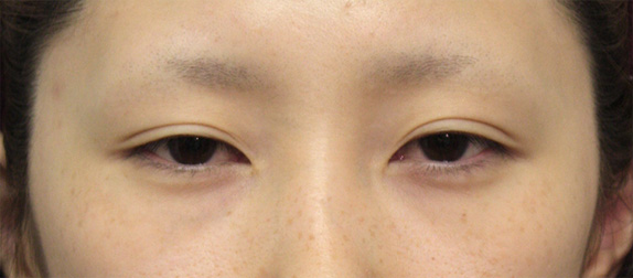 眼瞼下垂（がんけんかすい）,眼瞼下垂（がんけんかすい） まぶたが重そうな20代女性の症例,Before,ba_ganken26_b.jpg