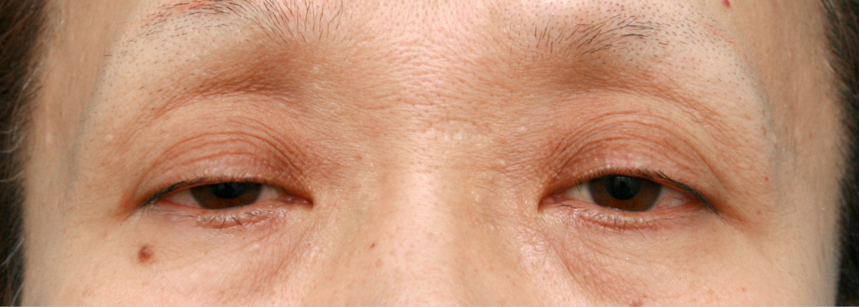 眼瞼下垂（がんけんかすい）,眼瞼下垂（がんけんかすい） 老人性眼瞼下垂で頭痛や肩こりに悩んでいた症例,Before,ba_ganken25_b.jpg