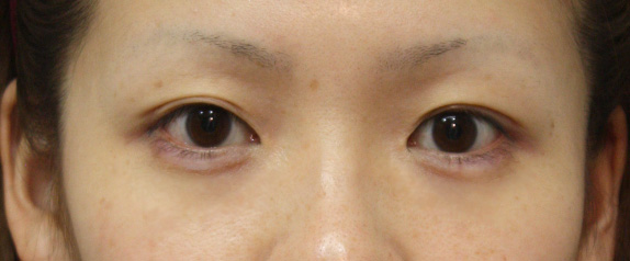 なみだ袋形成（ヒアルロン酸注射）の症例 淋しい顔立ちを解消したい女性,After,ba_namida04_a01.jpg