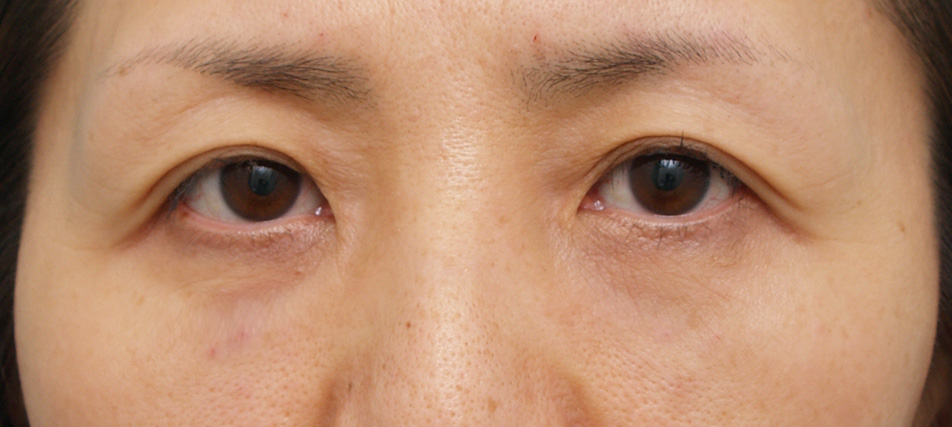 目の下のクマ治療,注射式シワ取り 長期持続型ヒアルロン酸注入,目の下のクマ治療の症例 くぼんで陰になっているタイプのクマにはヒアルロン酸注入,After,ba_kuma06_a01.jpg