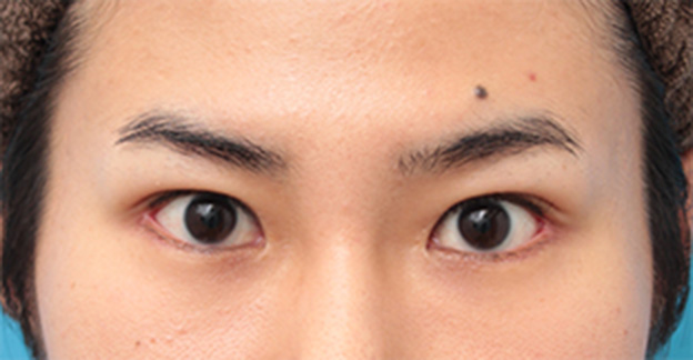 症例写真,目尻切開+タレ目形成（グラマラスライン）で目を一回り大きくした男性の症例写真の術前術後画像,1ヶ月後,mainpic_panda07d.jpg