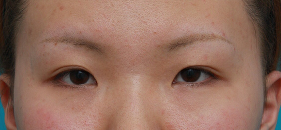 眼瞼下垂（がんけんかすい）,目頭切開+眼瞼下垂手術の症例写真,Before,ba_ganken44_b.jpg