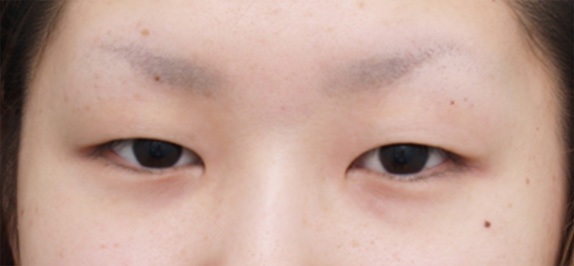 眼瞼下垂（がんけんかすい）,眼瞼下垂手術で幅の広い平行型二重まぶたを作った症例写真の術前術後画像の解説,Before,ba_ganken51_b.jpg