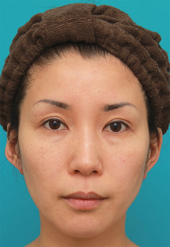 イタリアンリフトファイン,40代女性の顔全体にイタリアンリフトファインを行い、肌の張りを出した症例写真の術前術後画像,After,ba_italianlift_fine11_a01.jpg