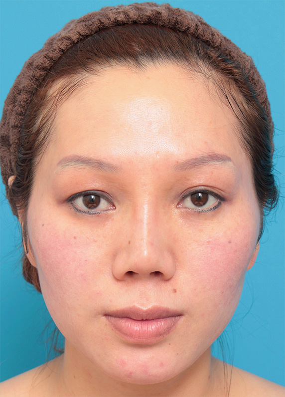 隆鼻術（シリコンプロテーゼ）,耳介軟骨移植（鼻先を出す）,鼻のシリコンプロテーゼ抜き（除去）,他院で受けた手術の修正（鼻）,L型シリコンプロテーゼをI型に入れ替え、耳介軟骨移植した症例写真,Before,ba_prosthesis_removal02_b.jpg