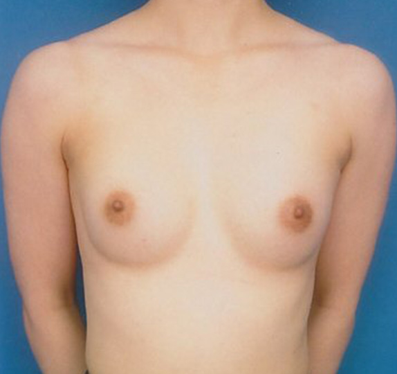 豊胸手術（シリコンプロテーゼ）,豊胸手術（シリコンプロテーゼ）の症例 大胸筋下に125CCずつ挿入,After,ba_hokyo40_a01.jpg