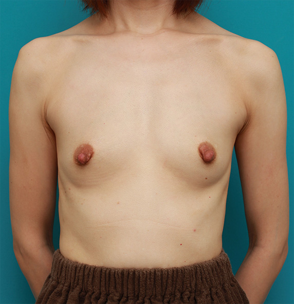 症例写真,豊胸手術と乳頭縮小手術を同時に行い、バランスのとれた自然な美乳を作った症例写真　左右125ccずつ,Before,ba_hokyo59_b.jpg