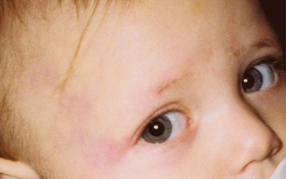 Vビーム,Vビームの症例写真 お子さんの生まれつきの血管腫を治療,After,ba_vbeam_laser_pic28_b.jpg