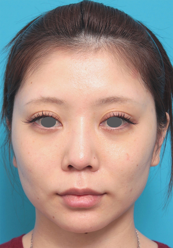 20代女性にウルセラシステムを行い、頬のたるみが引き締まり小顔になった症例写真 ウルセラシステム ： 美容整形の高須クリニック（東京赤坂