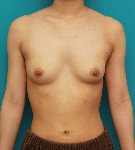 症例写真,胸がほぼ平らに近い女性に、ヒアルロン酸を50ccずつ注入し、ほどよい自然な膨らみを作った症例の術前術後画像,Before,ba_mammary57_b.jpg
