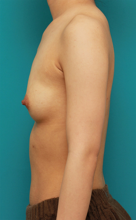 マンマリーヒアル（R）（プチ豊胸術・ヒアルロン酸豊胸術）,胸がほぼ平らに近い女性に、ヒアルロン酸を50ccずつ注入し、ほどよい自然な膨らみを作った症例の術前術後画像,Before,ba_mammary61_b.jpg