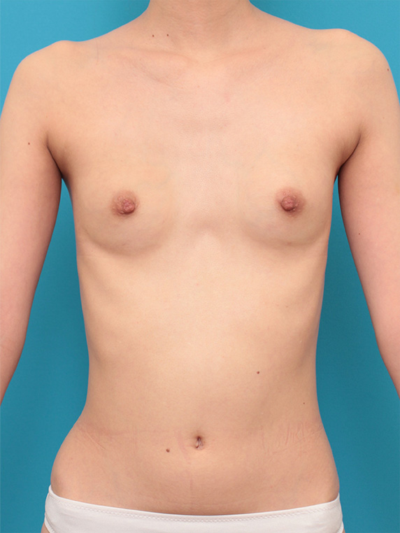 マンマリーヒアル（R）（プチ豊胸術・ヒアルロン酸豊胸術）,漏斗胸もあって非常に痩せている女性の胸にヒアルロン酸を40ccずつ注射し、バストに膨らみを出した症例の術前術後画像,After（1週間後）,ba_mammary68_a01.jpg