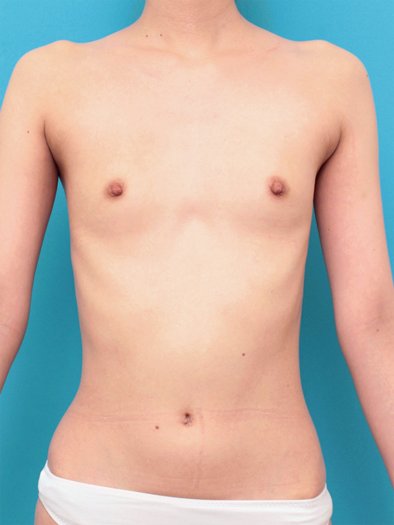 マンマリーヒアル（R）（プチ豊胸術・ヒアルロン酸豊胸術）,漏斗胸もあって非常に痩せている女性の胸にヒアルロン酸を40ccずつ注射し、バストに膨らみを出した症例の術前術後画像,Before,ba_mammary68_b.jpg