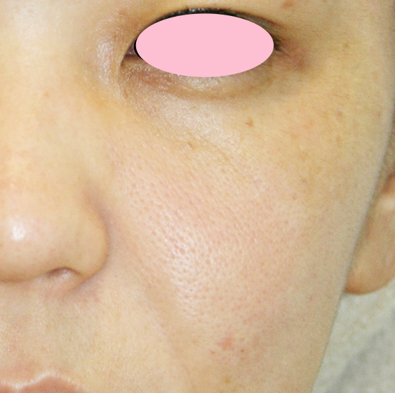 フォトフェイシャルM22の症例 目の下のシミと口横のニキビ跡を気にされていた患者様,Before,ba_rf_05_b.jpg
