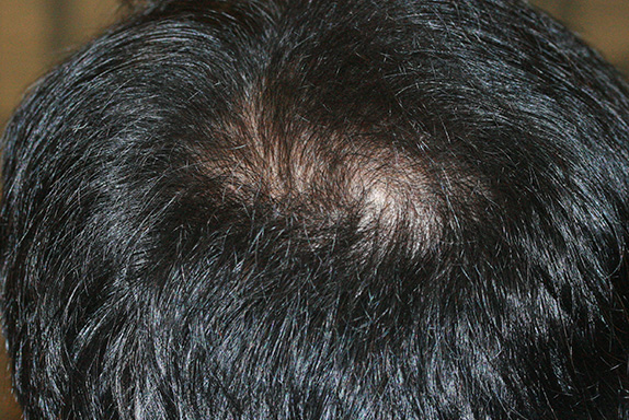 症例写真,AGA治療（高須式メディカル育毛プログラム）の症例写真24　HARG療法を施術,After（21週間後）,ba_aga_24_b.jpg