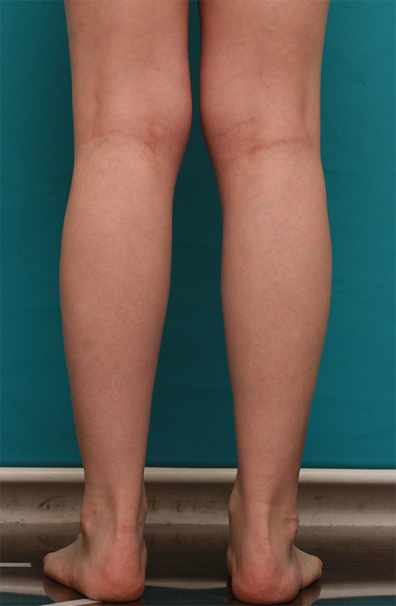 ボツリヌストキシン注射（ふくらはぎ・足やせ・美脚）,ボツリヌストキシン注射（ふくらはぎ・足やせ・美脚）で腓腹筋とヒラメ筋を萎縮させ、細い美脚にした症例写真の術前術後画像,After（3ヶ月後）,ba_leg13_b.jpg