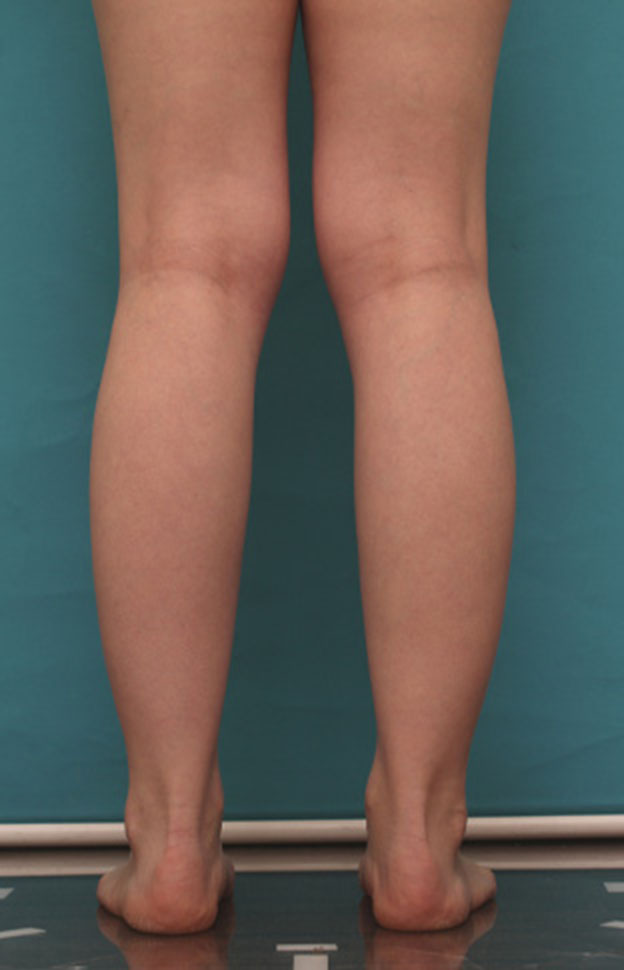 ボツリヌストキシン注射（ふくらはぎ・足やせ・美脚）,ボツリヌストキシン注射（ふくらはぎ・足やせ・美脚）で腓腹筋とヒラメ筋を萎縮させ、細い美脚にした症例写真の術前術後画像,1ヶ月後,mainpic_leg02c.jpg