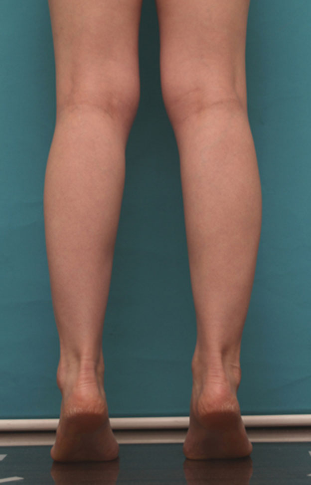 ボツリヌストキシン注射（ふくらはぎ・足やせ・美脚）,ボツリヌストキシン注射（ふくらはぎ・足やせ・美脚）で腓腹筋とヒラメ筋を萎縮させ、細い美脚にした症例写真の術前術後画像,1ヶ月後,mainpic_leg02g.jpg