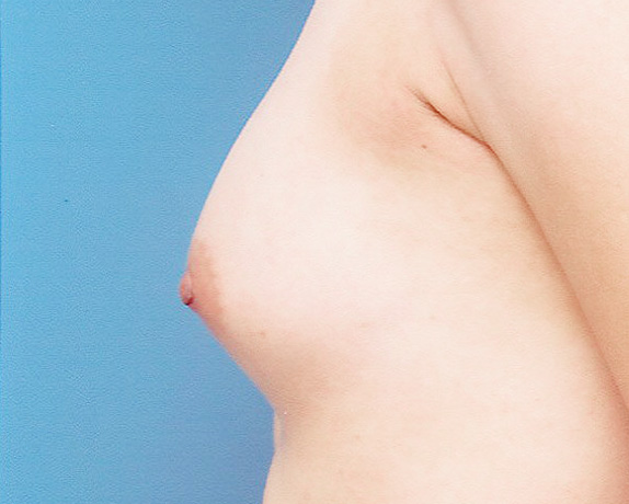 乳頭縮小,乳頭縮小の症例 薄い胸と大きな乳頭のアンバランスさが悩みの女性,After,ba_nyuto15_a01.jpg