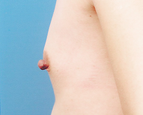乳頭縮小,乳頭縮小の症例 薄い胸と大きな乳頭のアンバランスさが悩みの女性,Before,ba_nyuto15_b.jpg