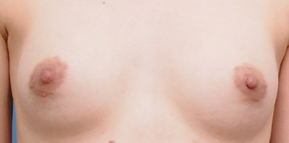 乳頭縮小,乳頭縮小 乳頭が伸びきって大きくなっていた女性の症例,After,ba_nyuto10_b.jpg