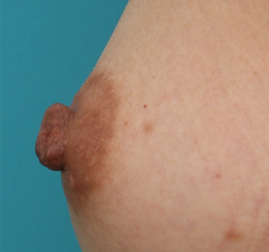 乳頭縮小の症例 胸のバランスに比べ乳頭が大きいことを気にされていた女性,Before,ba_nyuto21_b.jpg