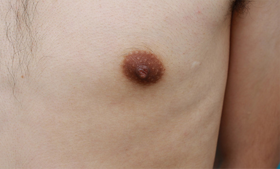 乳頭縮小,男性の乳頭縮小手術の症例写真,Before,ba_nyuto23_b.jpg