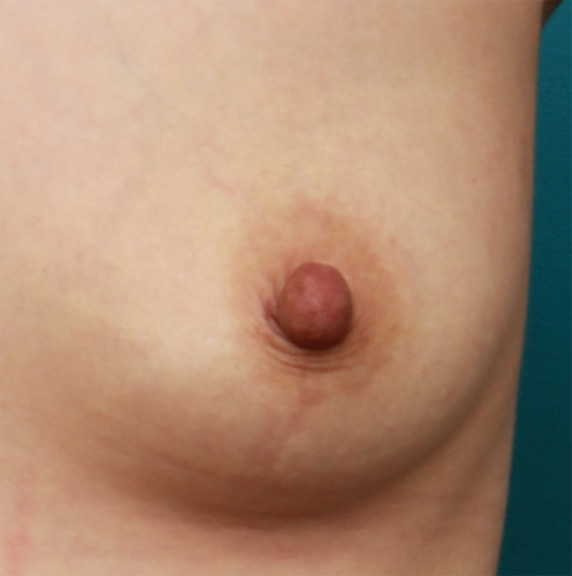 乳頭縮小,乳頭縮小の症例 バストの脂肪注入手術と同時に乳頭縮小も施術,Before,ba_nyuto25_b.jpg