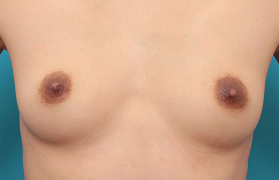 乳頭縮小,乳頭縮小手術でやや大きめな乳首を小さめにした症例写真の術前術後画像,After（3ヶ月後）,ba_nyuto31_a01.jpg