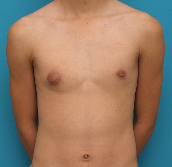 女性化乳房除去,女性化乳房修正手術の症例写真,Before,ba_gynecomastia_pic06_b.jpg