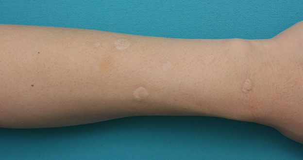 傷跡,傷跡修正の症例写真 タバコの火傷跡が目立つ皮膚を切り縫い合わせ修正,Before,ba_keisei15_b.jpg