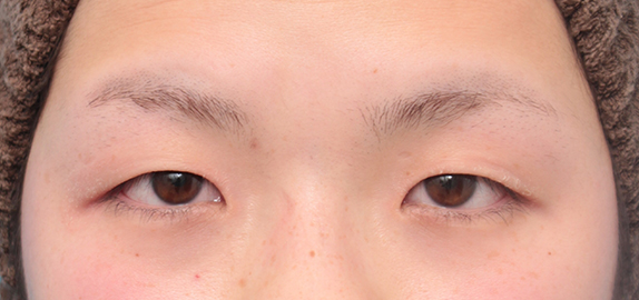 二重まぶた埋没法二針固定でタレ目気味の一重まぶたを目頭側もわずかに幅のある平行型っぽい二重にした症例写真の術前術後画像,Before,ba_maibotsu52_b.jpg